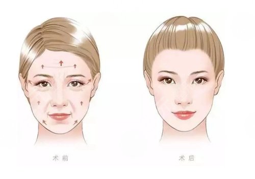 肤丽美胶原蛋白填充泪沟怎么样?