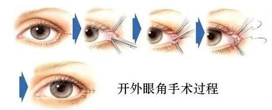 开眼角多长时间恢复呢?