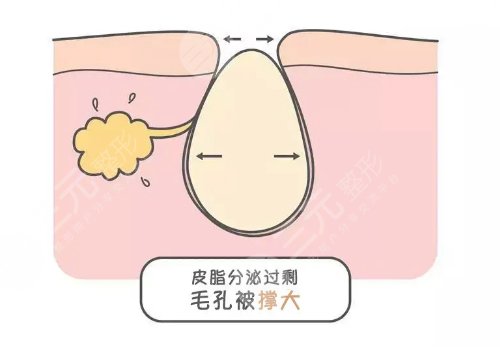 男士毛孔粗大是什么原因?