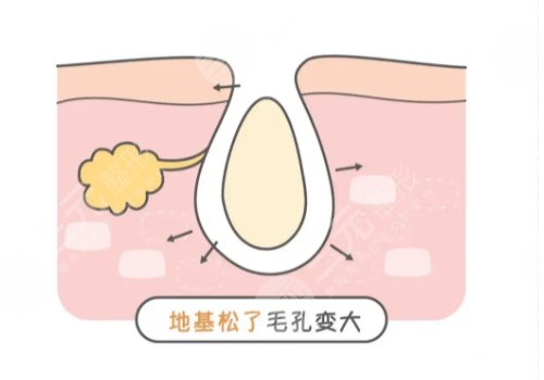 男士毛孔粗大是什么原因?