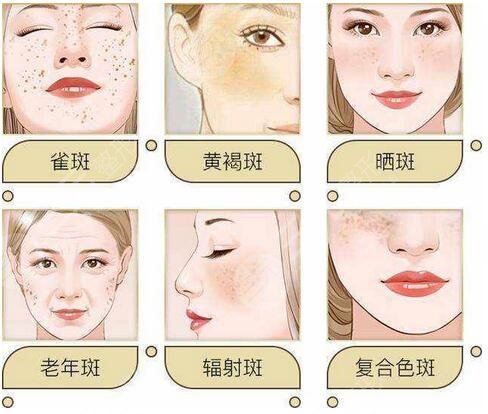 怎样去除老年斑