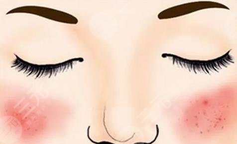 激光红血丝后多久恢复？会伤皮肤吗？