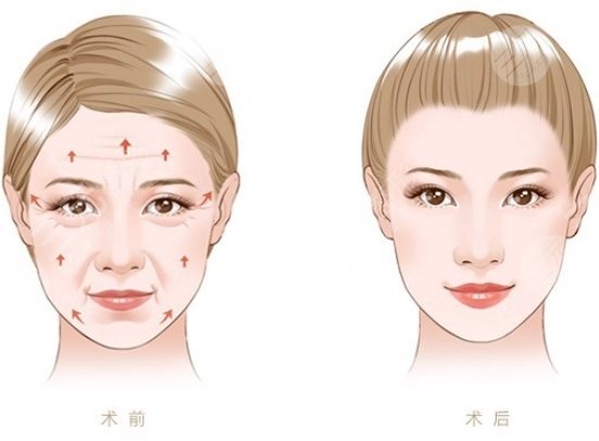 点阵激光除皱有吗