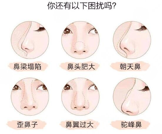 全肋骨鼻