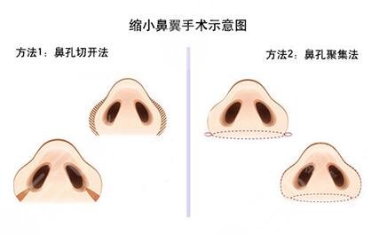 缩鼻翼手术多少钱