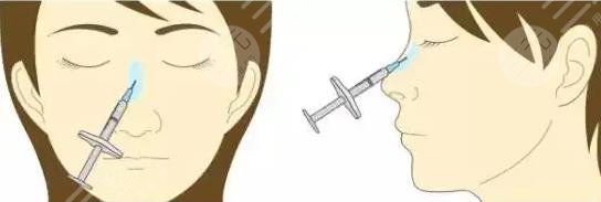 注射隆鼻的果怎么样