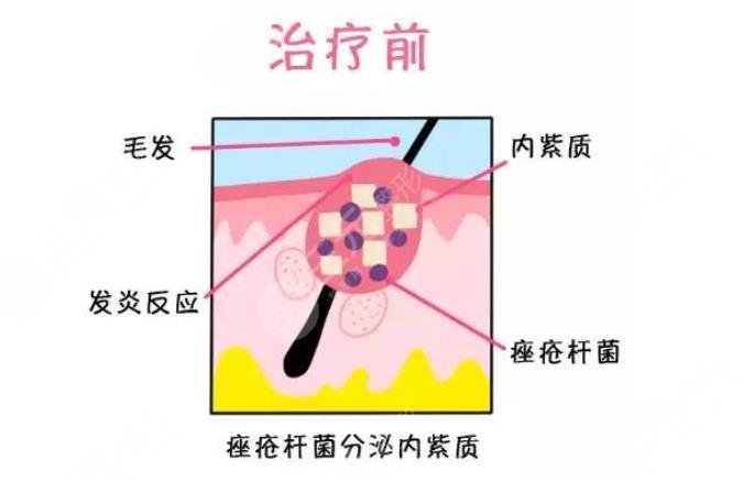 红蓝光