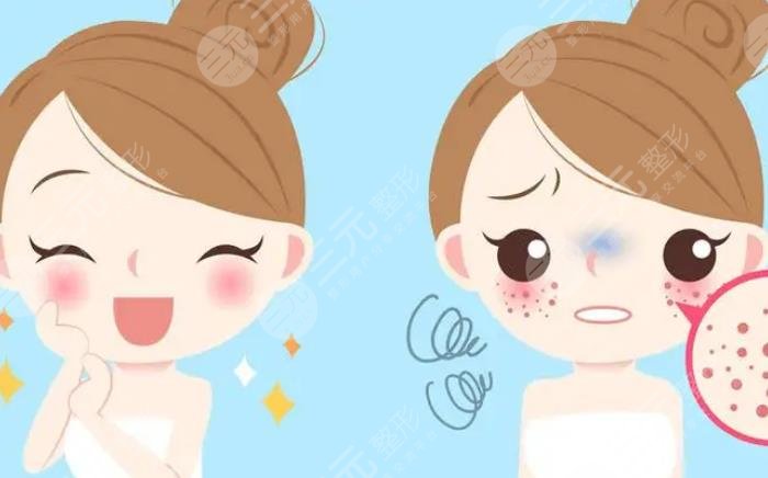 如何除青春痘