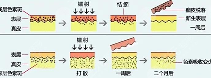 怎么除雀斑