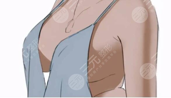 胸部整形有哪些方法？哪种方法手感、观感好，且比较的？一并告诉你！