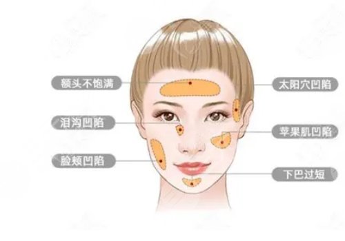 自体脂肪面部填充恢复维持几年?
