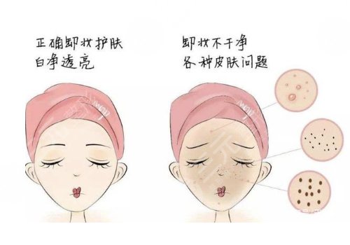 热玛吉一次多少钱?