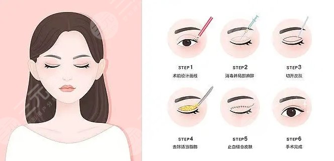 黎慧娟双眼皮