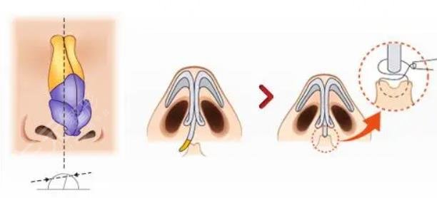 鼻修复是取出来直接做吗?