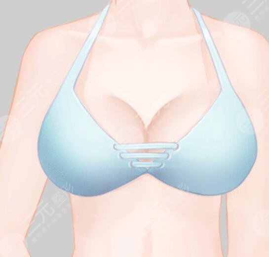 丰乳手术哪种性更高？手术是首要指标，其次才是术后果保障~