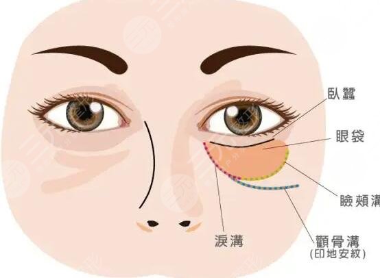 光乳化去眼袋手术原理