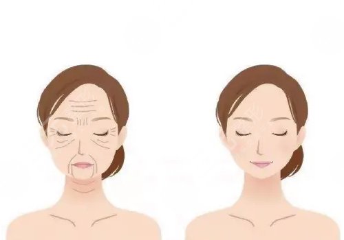 面部拉皮手术可以保持多久？