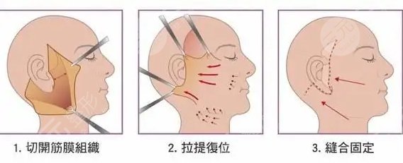 筋膜拉皮是什么意思