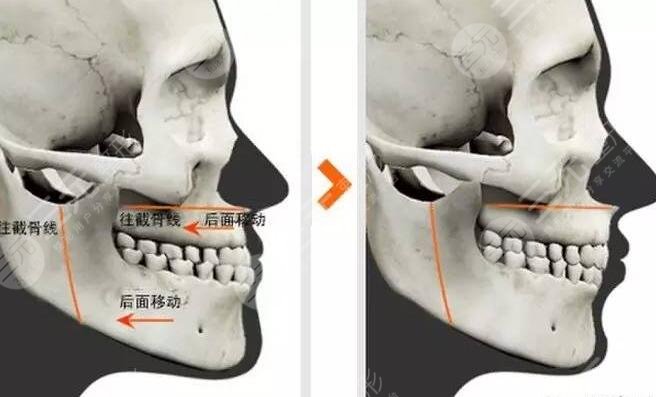 微创颧骨整形原理