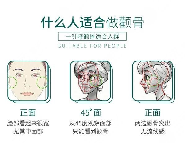 微创颧骨整形注意事项