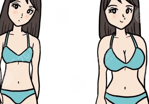傲若拉假体价格多少钱？