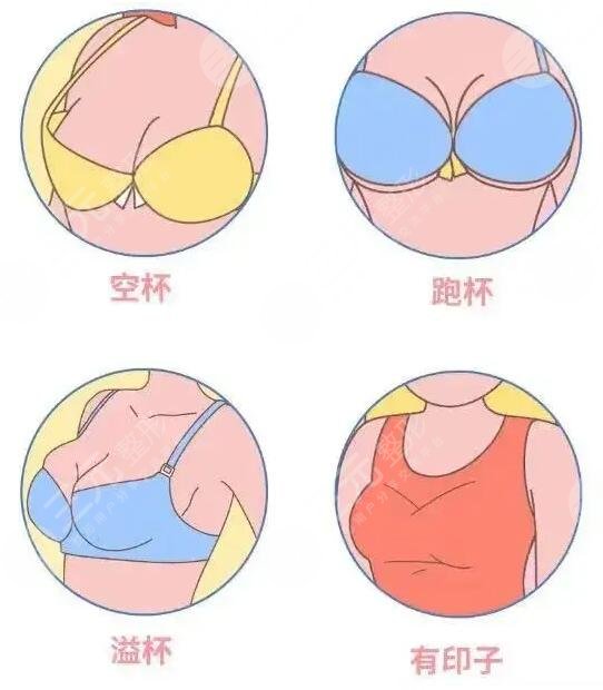 傲若拉假体术后注意事项