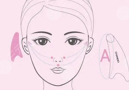 v-line瓜子脸手术注意事项