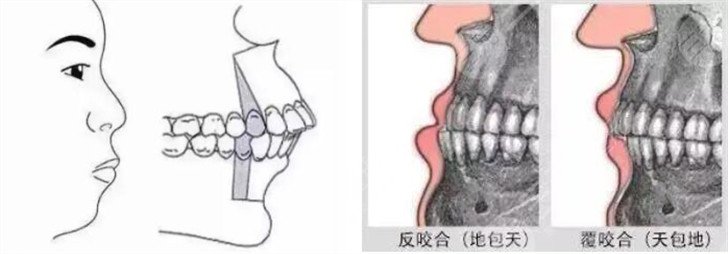 包地矫正后脸型变化图