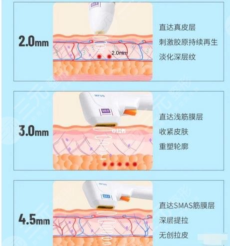 超声炮做一次能维持多久？附上好处+注意事项盘点！"贵妇"轻医美解读~