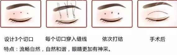 埋线双眼皮一到7天图片