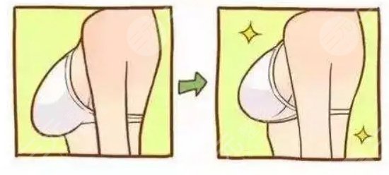 棒棒糖法缩胸是什么