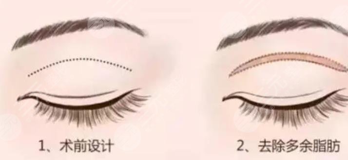全切双眼皮