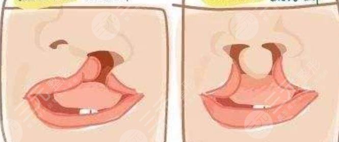 唇腭裂修复