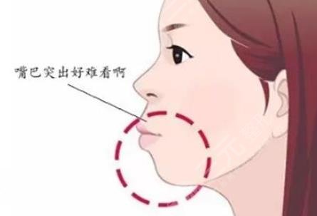 凸嘴整形