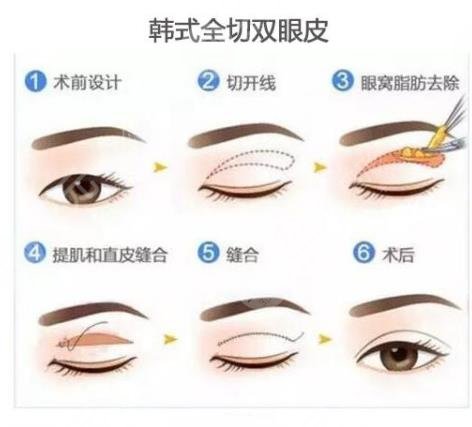 双眼皮