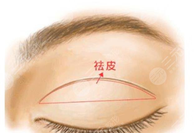 双眼皮