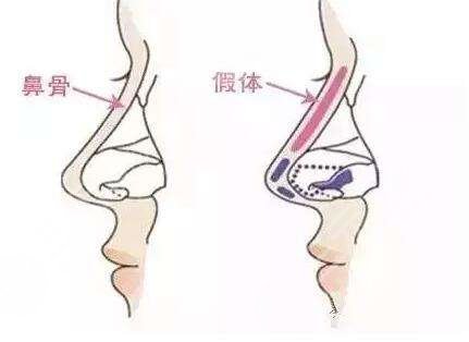 耳软骨隆鼻