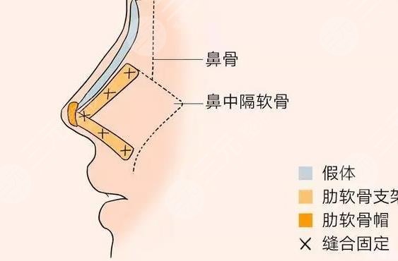 肋软骨隆鼻