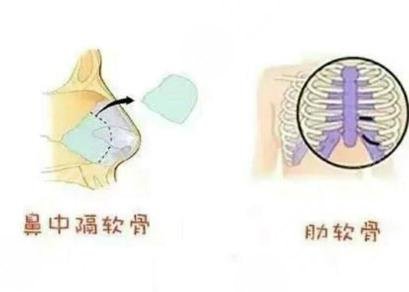 肋软骨隆鼻