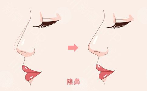 隆鼻.
