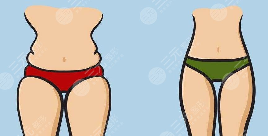 吸脂瘦大腿