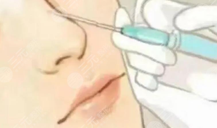 注射隆鼻