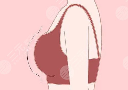 杭州格莱美医疗美容医院隆胸怎么样？