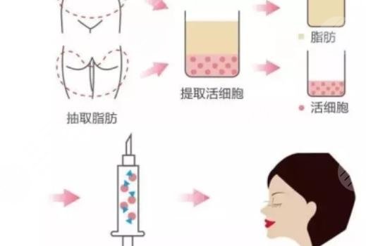 脂肪填充