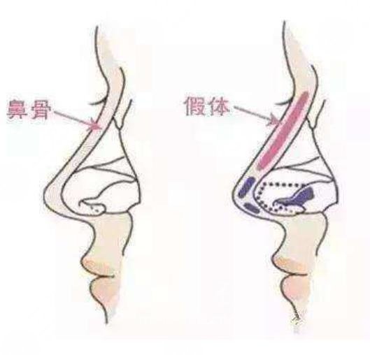 隆鼻