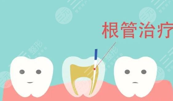 根管治疗