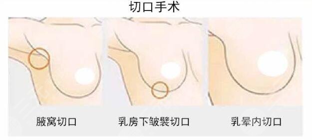 上海华美丰胸方式有哪些?