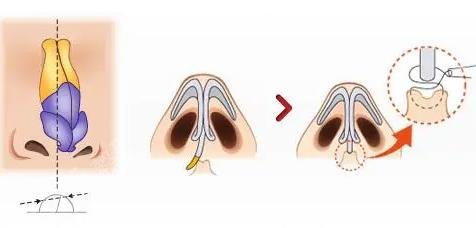 歪鼻矫正