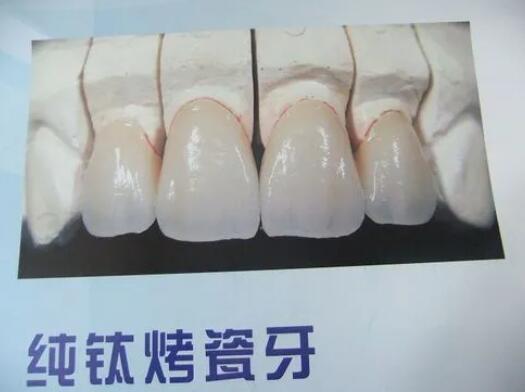 纯钛烤瓷牙多少钱一颗价格表2024，使用寿命！