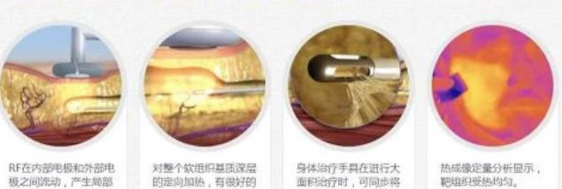 吸脂